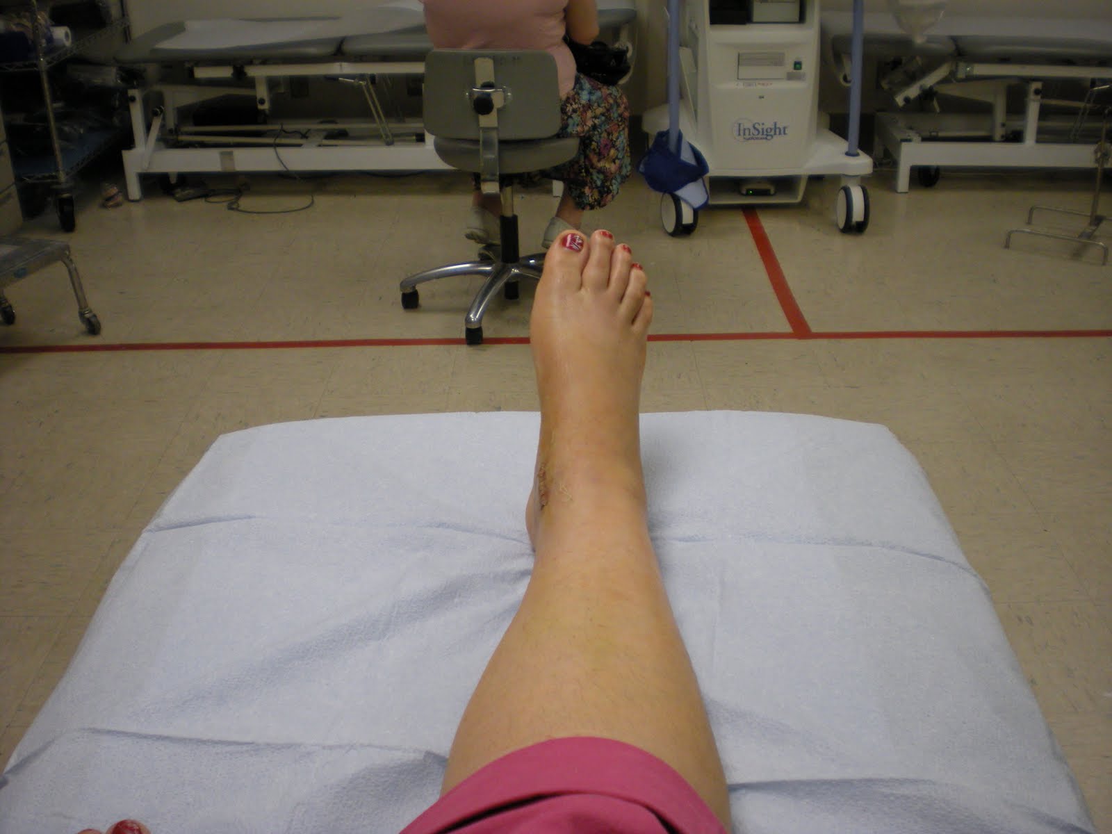 Can Staples Get Wet After Surgery at Johnnie Grogg blog