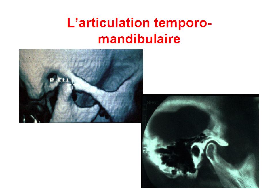 Dental ebooks L'articulation temporomandibulaire