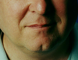 cleft.jpg