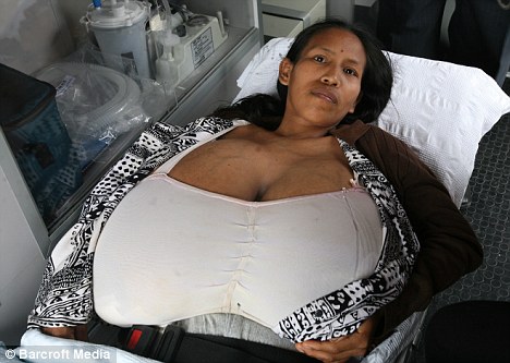 Wonder Blog: Mother left bedbound by N cup breasts has operation to remove  2.5 stone of flesh from her chest
