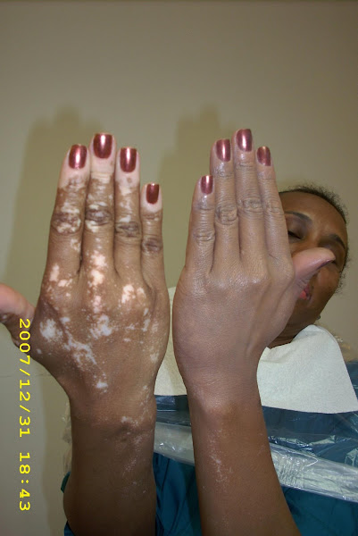 Hands Before & After professional application