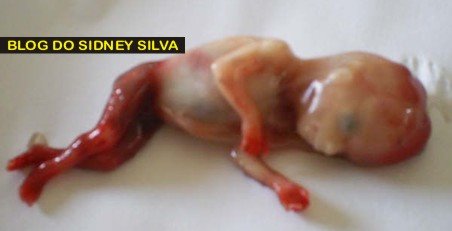 Resultado de imagem para aborto 3 meses