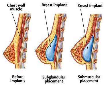 From Infection to Lymphoma: Breast Augmentation 