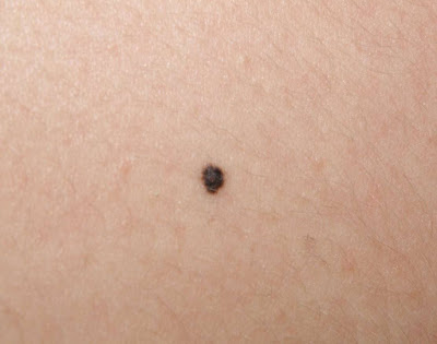 Causes of Brown Spots on the Skin | LIVESTRONG.COM