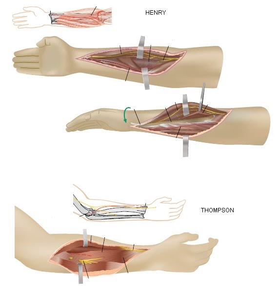 11:50: Abordajes de Antebrazo