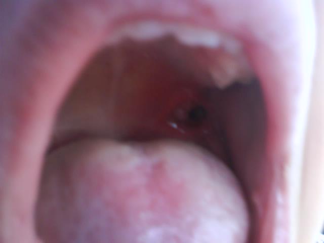 Hole In Back Of Throat 77