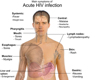 Aids