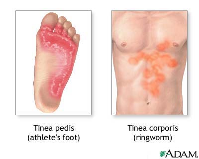 [tinea.jpg]