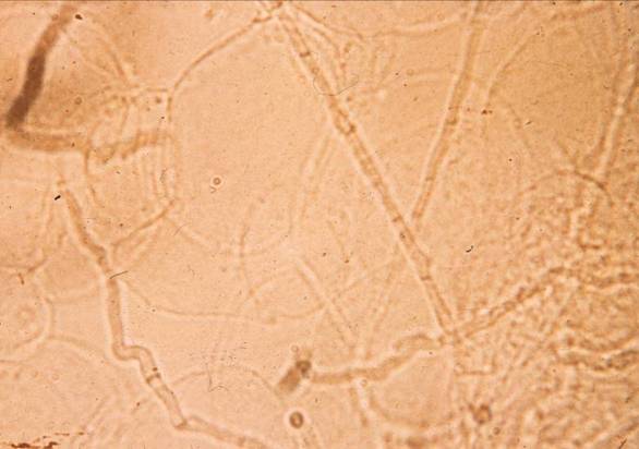 [KOHdermatophyte.jpg]