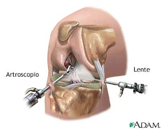 cirugia lesion rodilla artroscopia