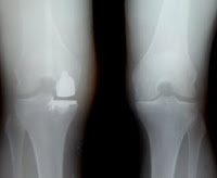 Left Knee Xray