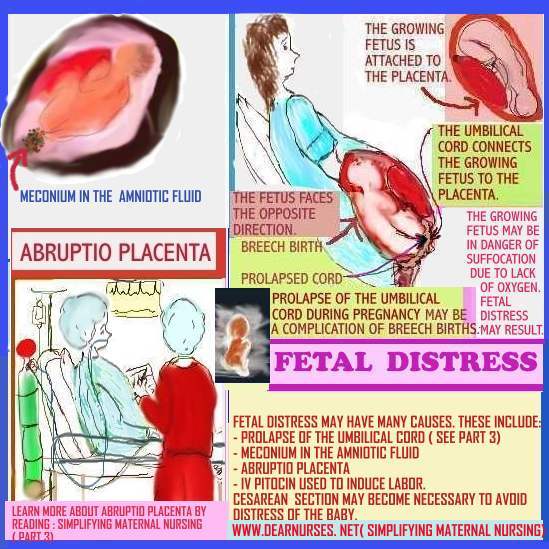 fetal-distress-nonreassuring-fetal-status