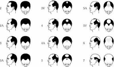 Know Your Hair Loss Pattern | Be Hair Aware