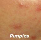 [Pimples.jpg]