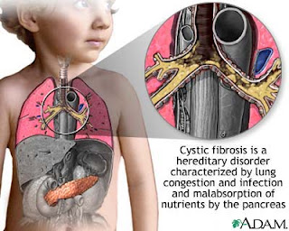 What Is Cystic Fibrosis?