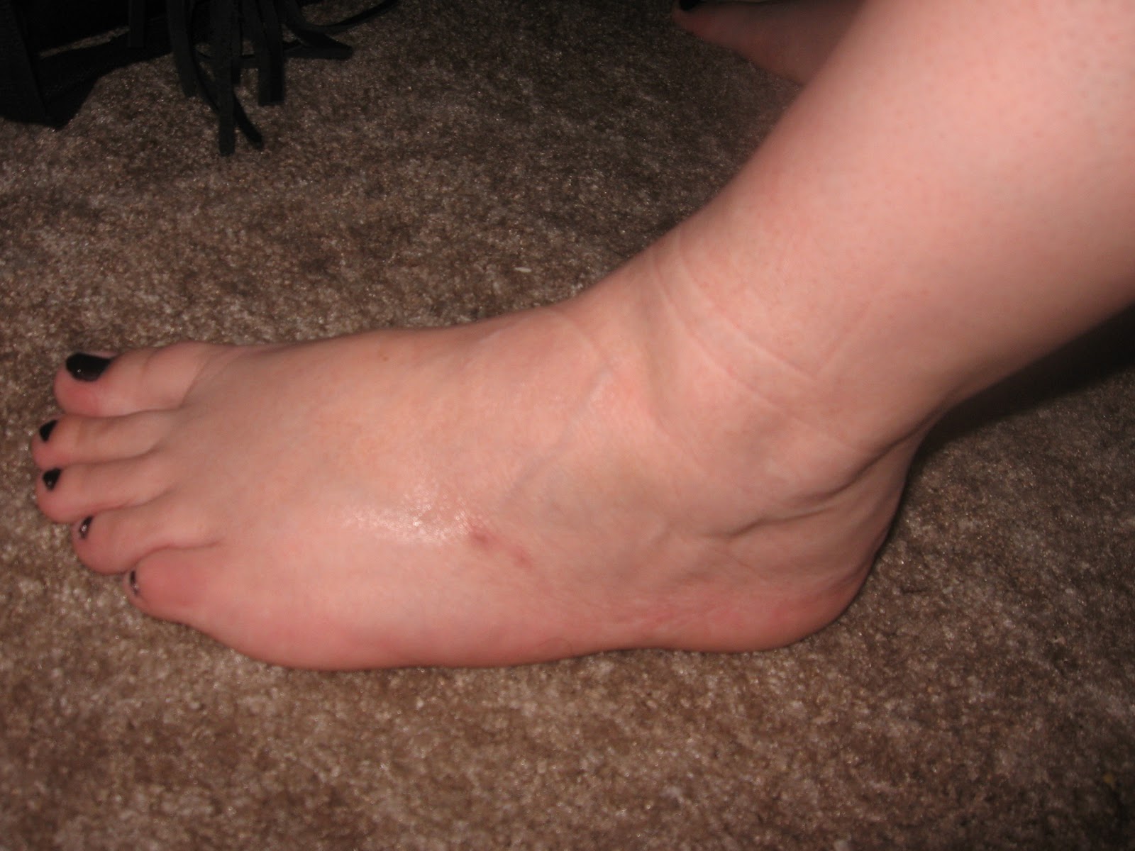 Swelling On Top Of Feet 23