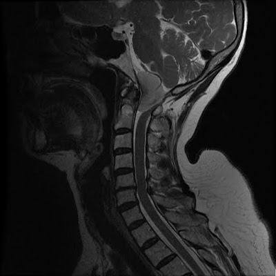 Radiology Cases: CCJ Meningioma