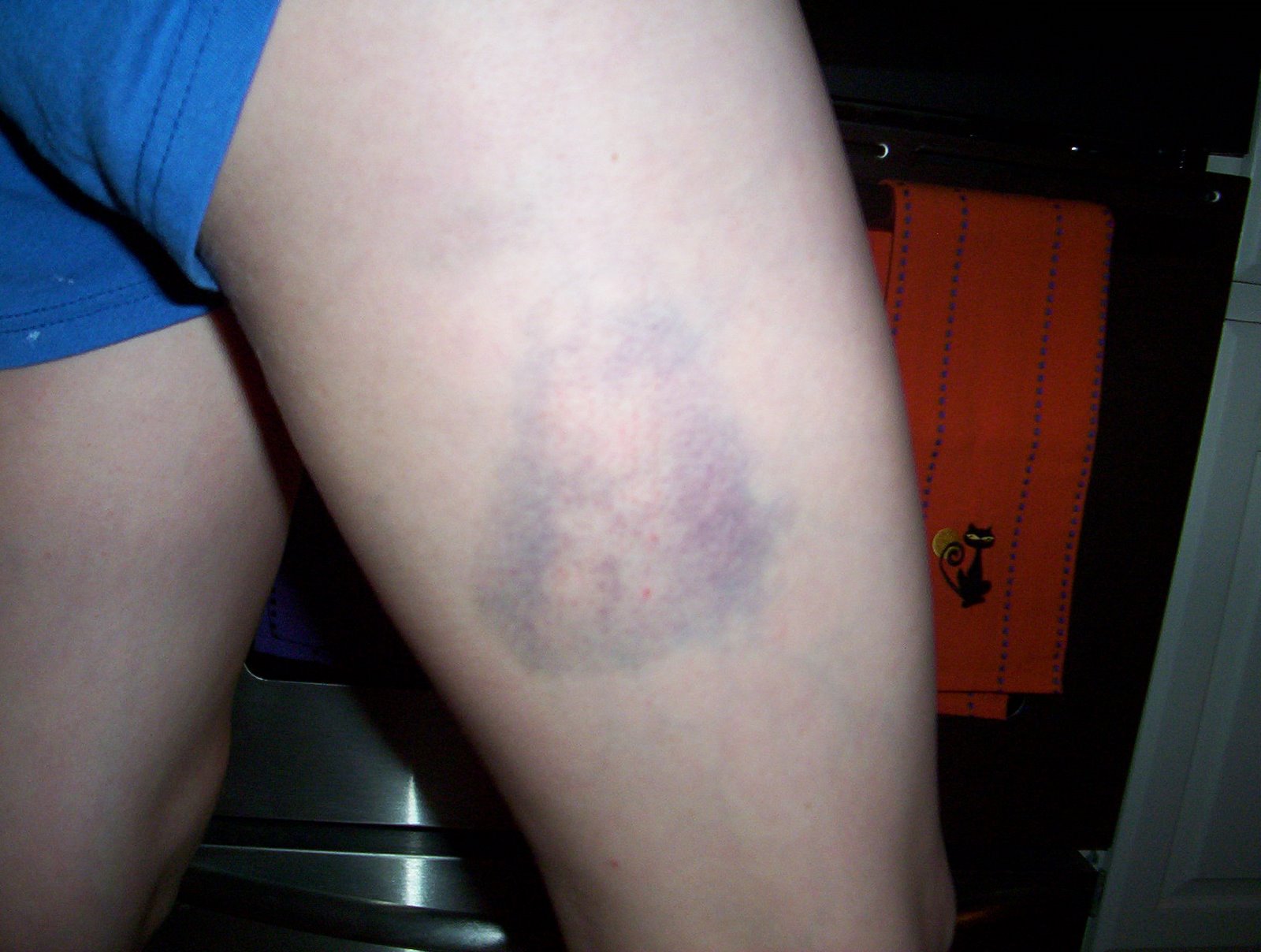 [Leg+Bruise+001.jpg]
