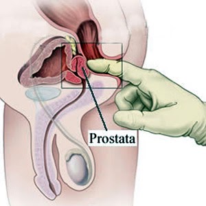 Semne si simptome adenom de prostata