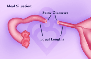 tubal reversal after ectopic surgery critical risk zone enter rate does when