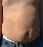 cold induced urticaria #10