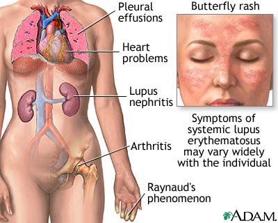 Systemic Lupus Erythematosus And Its Effects On