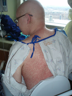 Charles Garrett's Bone Marrow Transplant Blog: Managing Graft vs Host