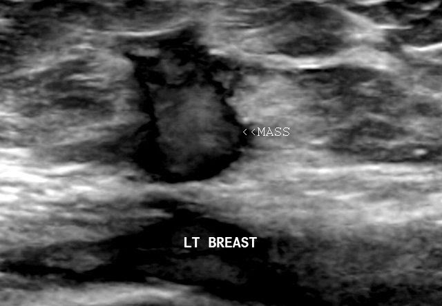 Ultrasound imaging: Breast cancer with spread to lymph nodes: