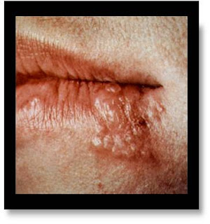 East African Nurses: Physical Assessment Lecture (mouth,pharynx)