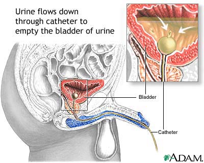 Urinary Infection, మూత్రంలో ఇన్‌ఫెక్షన్‌