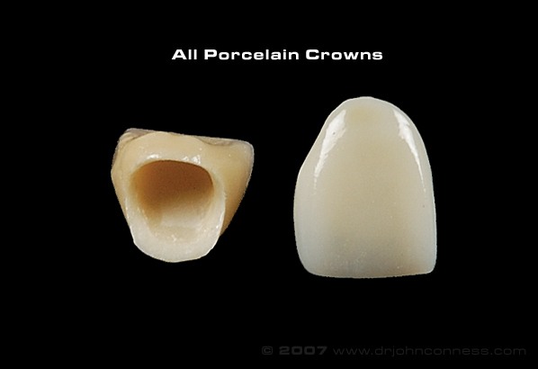 [all porcelain crown.jpg]
