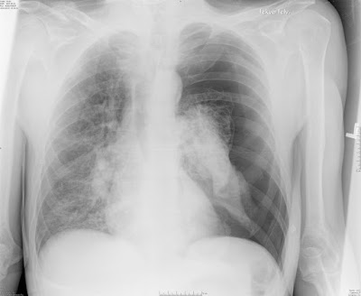 Pneumothorax