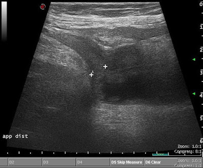 Gangrenosus appendicitis