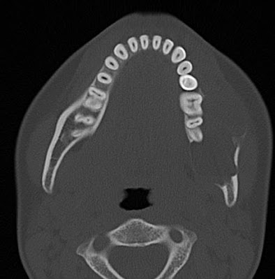 Unicysticus ameloblastoma (mandibula)