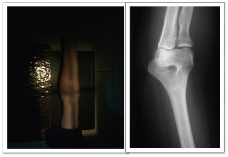 Guía multimedia en procesos de radiología RADIOGRAFIA DE CODO EN