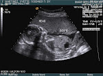 Santino @ 20 wk ultrasound