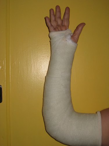 Gallery of Both Arms In Casts.