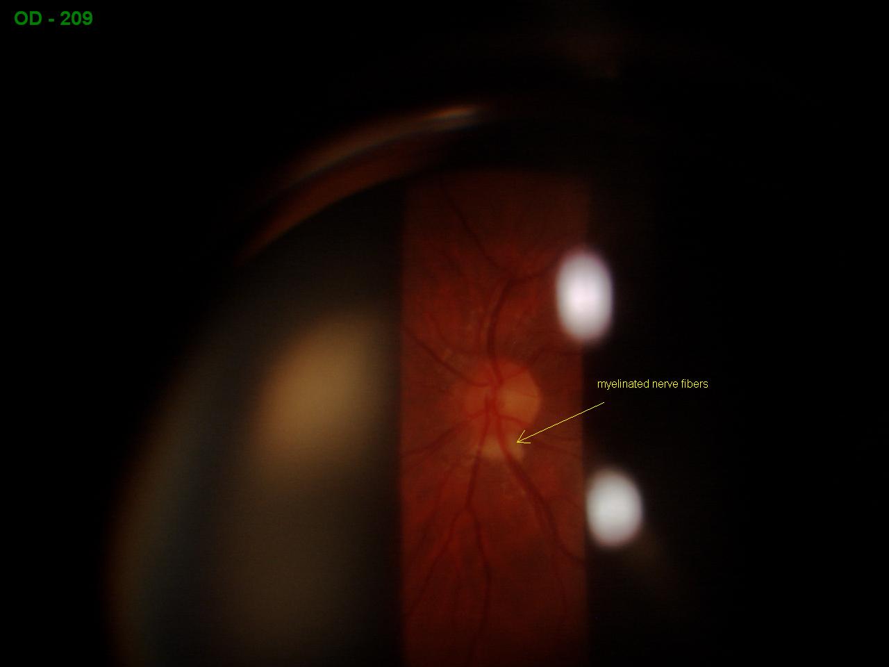 Sonoran Desert Eye Center MYELINATED NERVE FIBERS AND VITREORETINAL TUFT