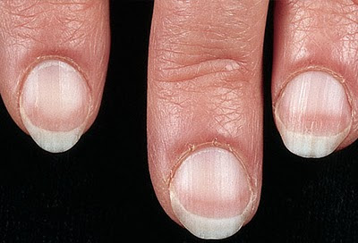 This Lady's Manicurist Spotted Melanoma Under Her Nail