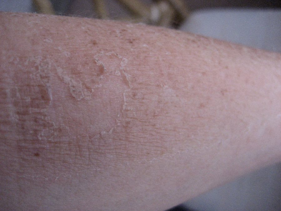 Chemical Peels for Acne and Anti Aging TCA 50 Chemical peel before