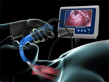 GlideScope  Video Laryngoscopes