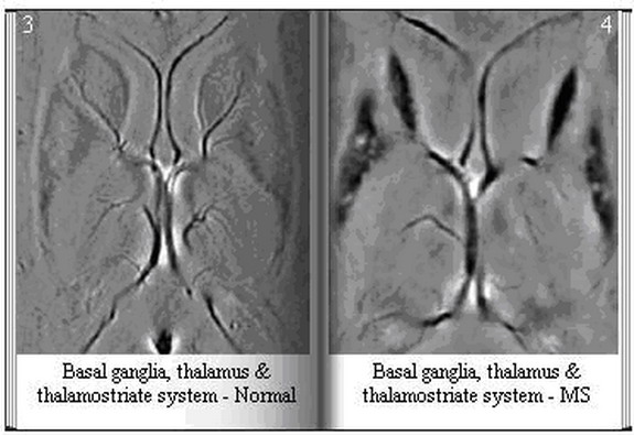 Basal Ganglia, Thalamus & Thalamostriate System