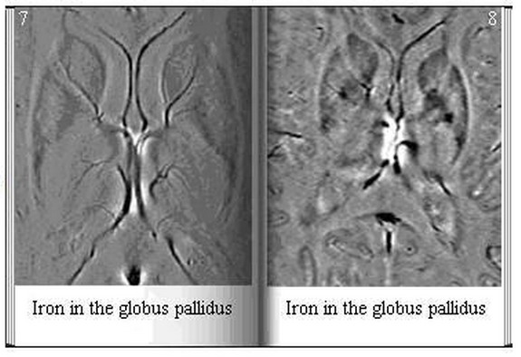 Iron in the Globus Pallidus