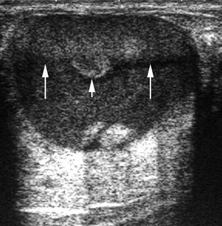 RadiologySpirit Breast galactocele radiologyspirit-breast-galactocele