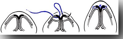 rhinoplasty tip surgery