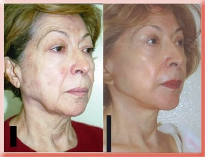 facelift