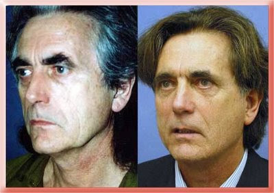 subperiosteal facelift