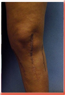 wide flat knee scar
