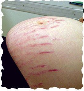 abdominal stretchmarks of pregnancy