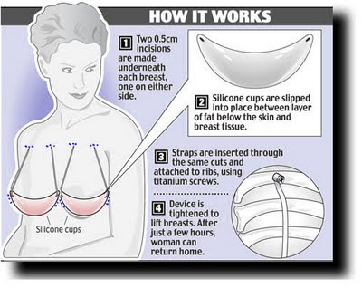 Internal Bra Breast Lift Los Angeles